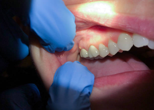 Best Root Canal Emergency Dentist  in Forestde, AL